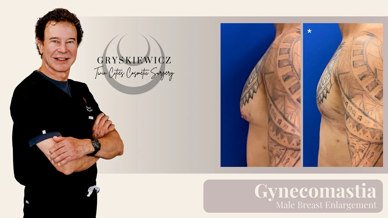 Learn about Gynecomastia