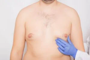 Are Man Boobs Hereditary?, Causes of Man Boobs